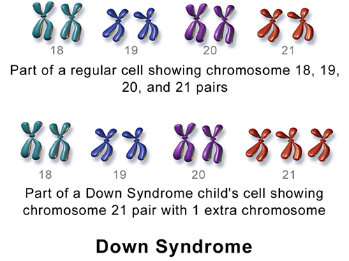 Down-syndrome-Genes